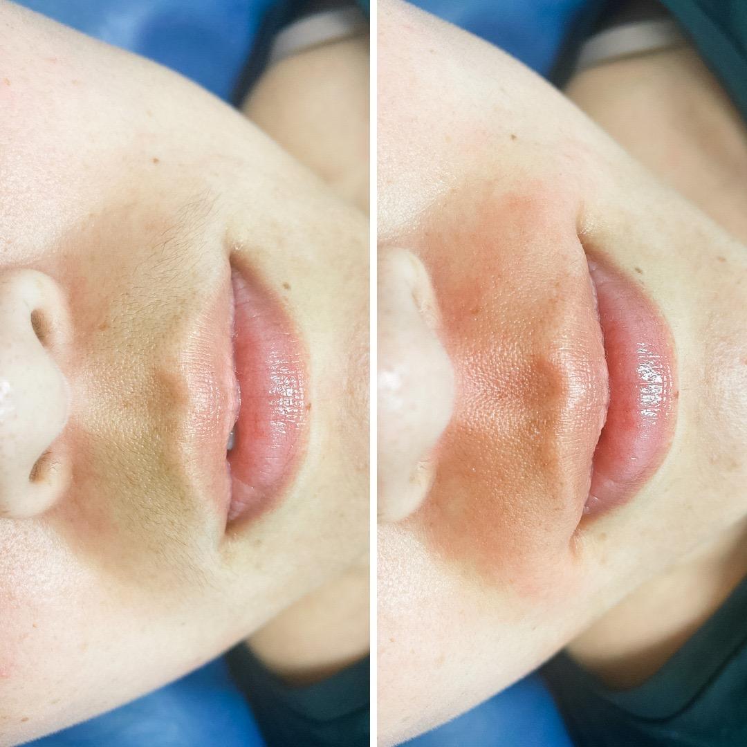 Before & After Upper Lip Wax